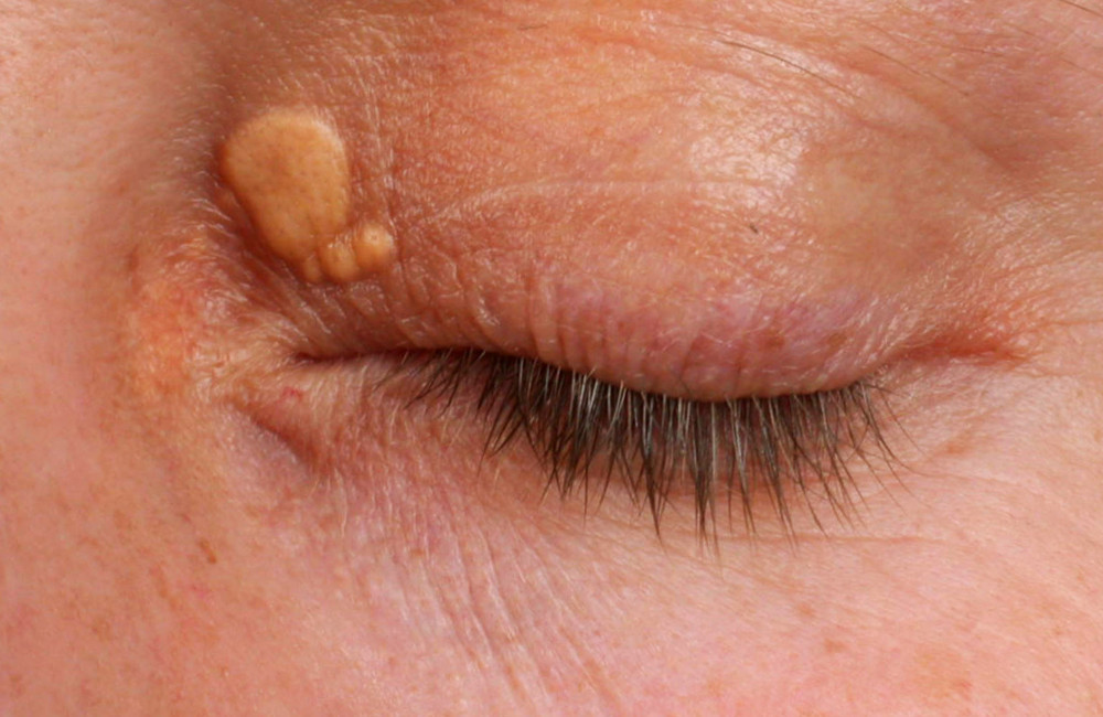 Yellow eye lumps linked to heart risk